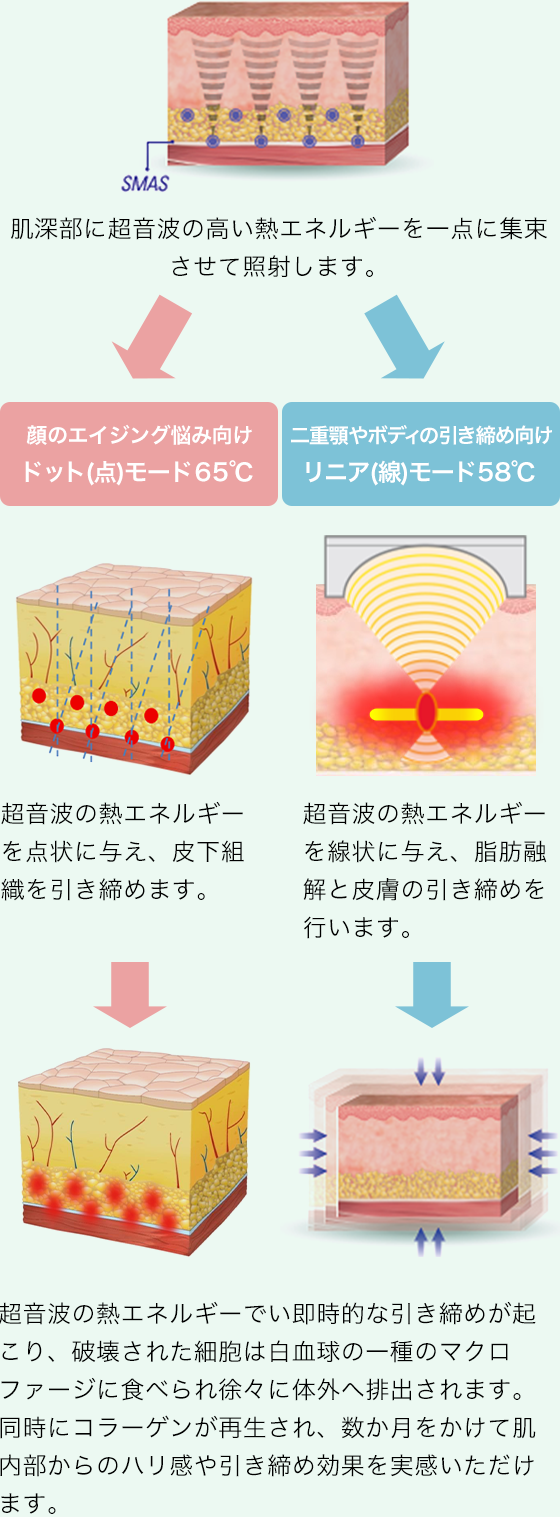 肌深部に超音波の高い熱エネルギーを一点に集束させて照射します。 超音波の熱エネルギーを点状に与え、皮下組織を引き締めます。 超音波の熱エネルギーを線状に与え、脂肪融解と皮膚の引き締めを行います。 超音波の熱エネルギーでい即時的な引き締めが起こり、破壊された細胞は白血球の一種のマクロファージに食べられ徐々に体外へ排出されます。同時にコラーゲンが再生され、数か月をかけて肌内部からのハリ感や引き締め効果を実感いただけます。